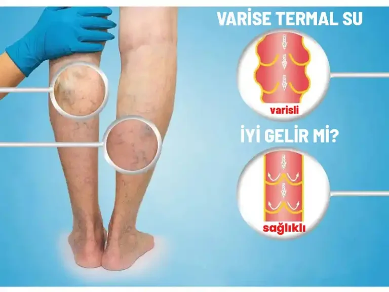 varise termal su iyi gelir mi